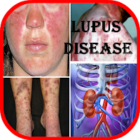 Lupus: Causes, Diagnosis, and 