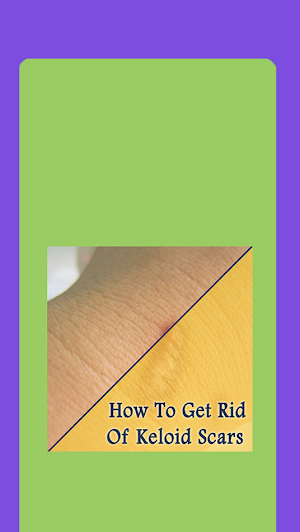 How To Get Rid Of Keloid Scars Screenshot 0
