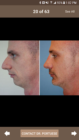 Rhinoplasty with Dr. Portuese Screenshot 1