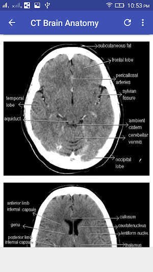 CT Brain Interpretation Screenshot 2