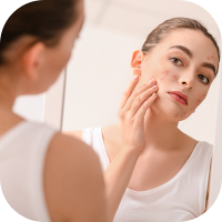 natural acne treatment