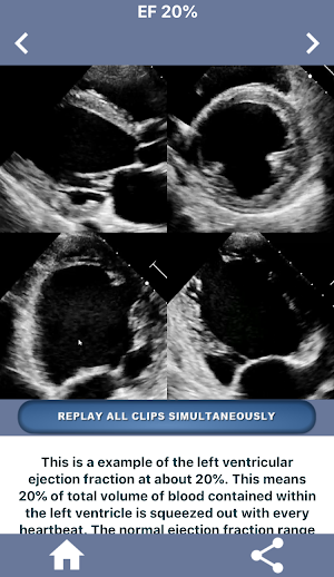 HEART EJECTION FRACTION: HOW TO EYEBALL THE EF Screenshot 3