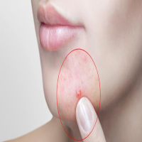 Facial acne treatment