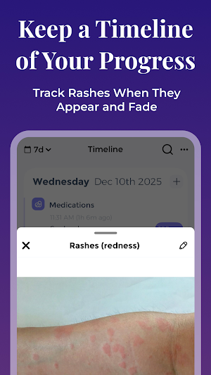 Lupus Tracker Screenshot 1
