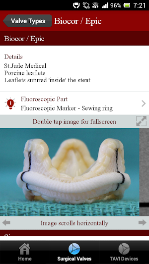 ViV Aortic Screenshot 2
